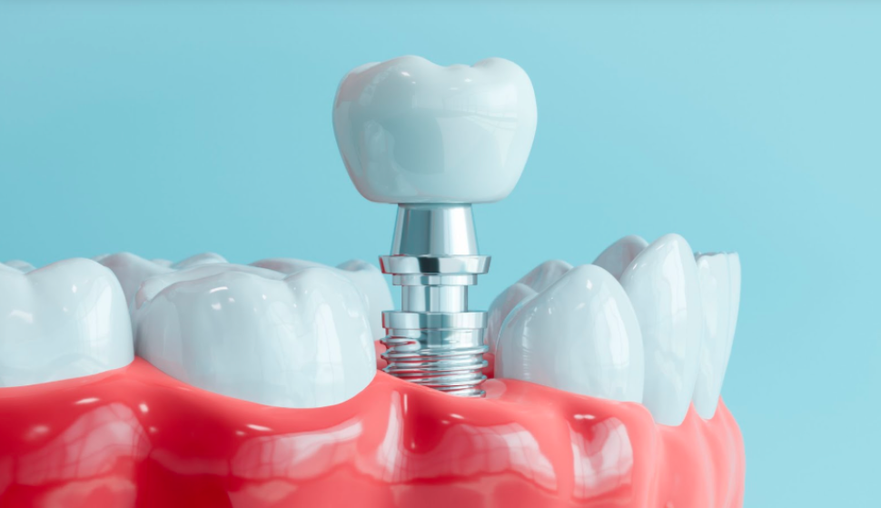 Are Dental Implants Worth It Long-Term