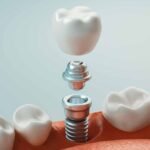 How Long Do Dental Implants Last