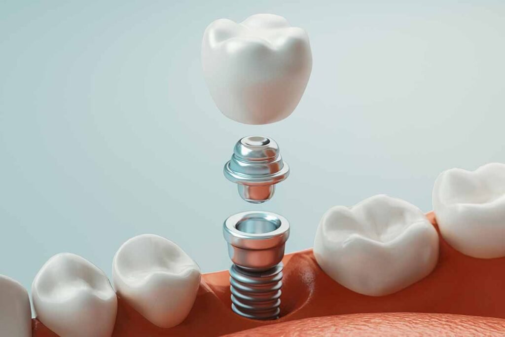 How Long Do Dental Implants Last