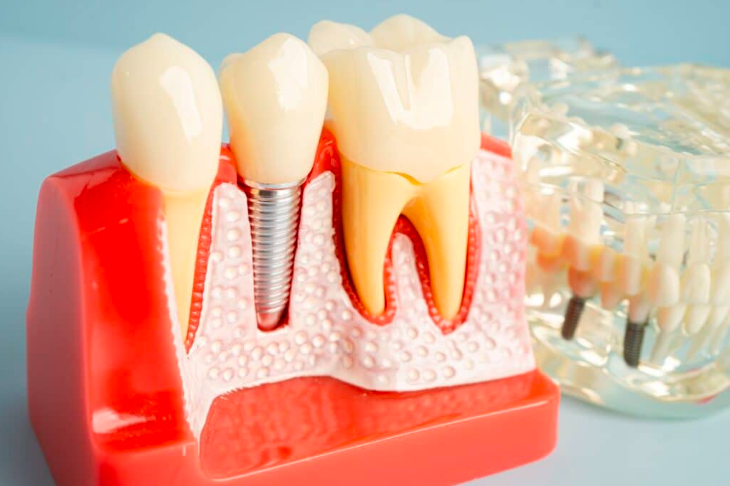 How to Make Dental Implants Last Longer?
