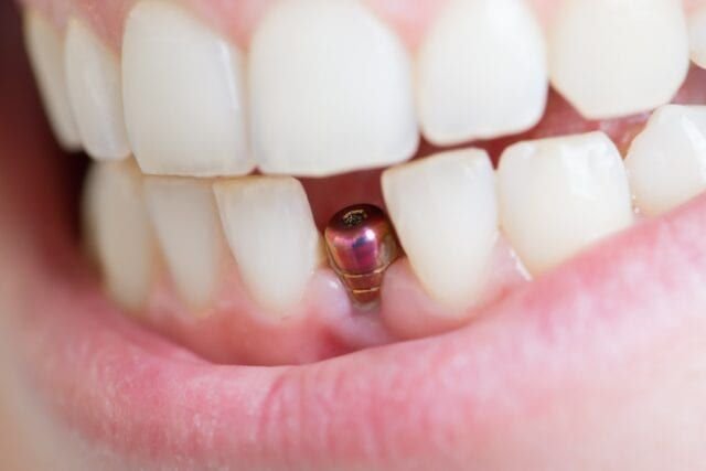 What Are Dental Implants
