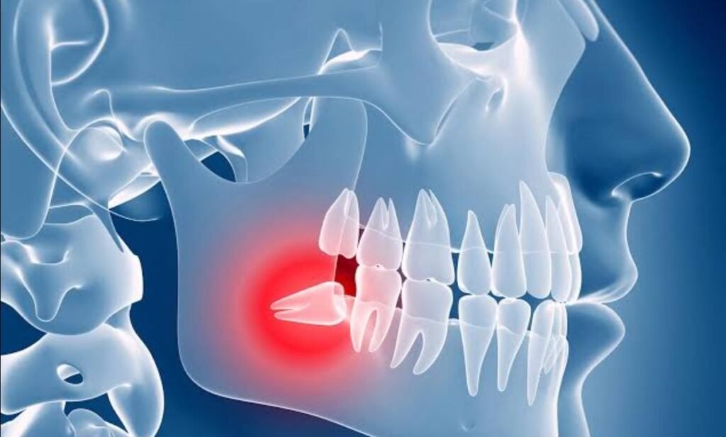 Causes of Wisdom Tooth Pain 