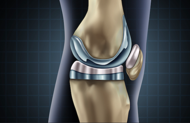 Long-Term Expectations After Knee Replacement
