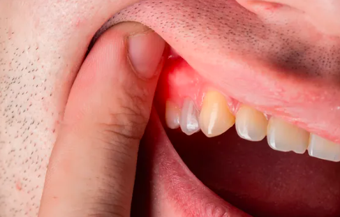 What Is Wisdom Tooth Pain? 