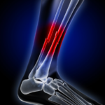 What's the Difference Between a Fracture and a Broken Bone