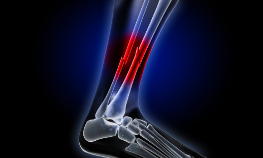 What's the Difference Between a Fracture and a Broken Bone