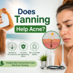 Does Tanning Help Acne What