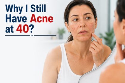 Why I Still Have Acne at 40