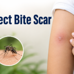 Insect Bite Scar