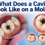 What Does a Cavity Look Like on a Molar?