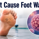 What Cause Foot Warts?