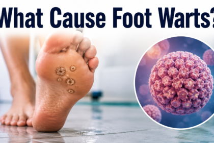 What Cause Foot Warts?