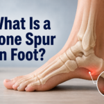 What Is a Bone Spur in Foot?